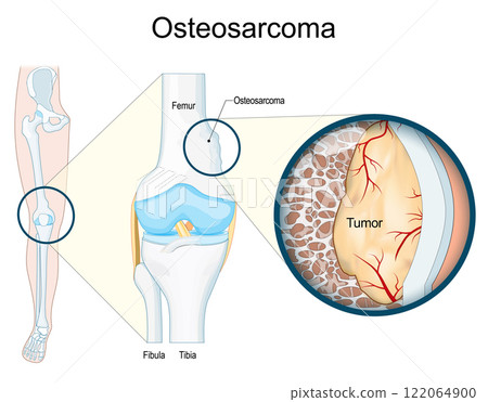 Osteosarcoma. Malignant bone tumor. 122064900