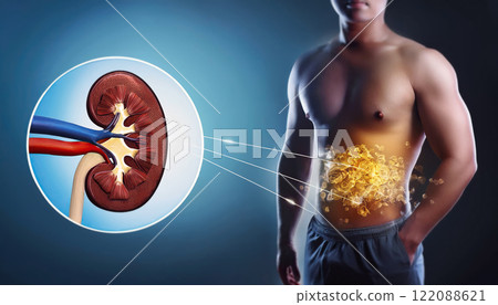 Human kidney stones medical concept. Sore organ with painful mineral formations 122088621