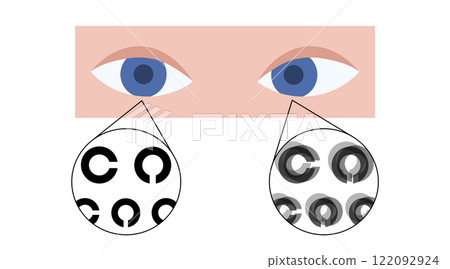 Amblyopia or lazy eye 122092924