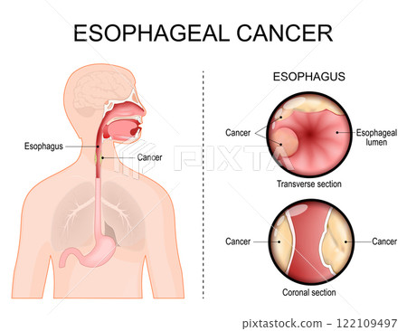 Esophageal cancer. Adenocarcinoma 122109497