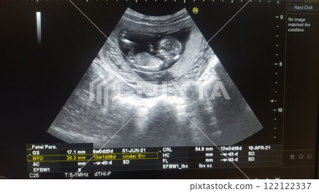 Ultrasound Image of Fetus in Early Pregnancy Stages for Expectant Parents and Families Ultrasound Image of Fetus in Early Pregnancy Stages for Expectant Parents and Families 122122337