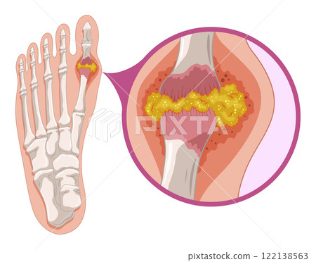 Gout diagram in human foot with crystallization of uric acid joint. Medical educational poster infographic scheme with inflammatory arthritis. Orthopedic disease vector illustration Gout diagram in human foot with crystallization of uric acid joint. Medical educational poster infographic scheme with inflammatory arthritis. Orthopedic disease vector illustration 122138563