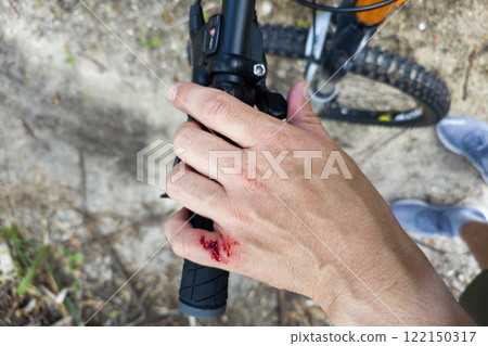 Mountain bike accident. Rider hand wound with red blood from hitting a tree stump 122150317