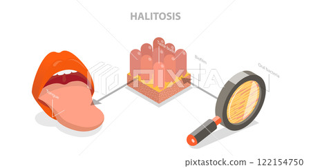 3D Isometric Flat  Illustration of Halitosis, Bacterial Causes of Bad Breath 122154750