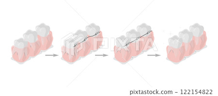 3D Isometric Flat  Illustration of Dental Teeth Braces, Orthodontic Care 122154822