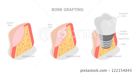 3D Isometric Flat Illustration of Bone Grafting, Understanding of Teeth Structure for Successful Treatment 3D Isometric Flat Illustration of Bone Grafting, Understanding of Teeth Structure for Successful Treatment 122154843