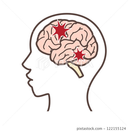 Illustration of a damaged brain Illustration of a damaged brain 122155124