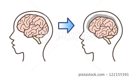 大腦插圖阿茲海默症癡呆 122155391