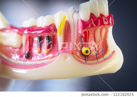 Tooth decay dental model Tooth decay dental model 122182025