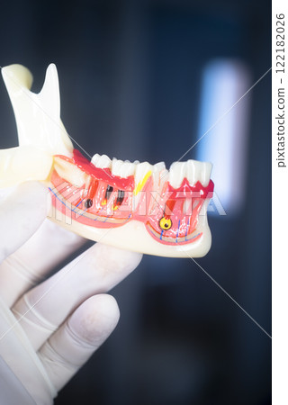 Tooth decay dental model Tooth decay dental model 122182026