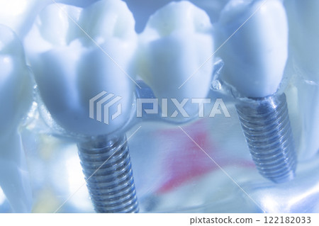 Dental tooth implant Dental tooth implant 122182033