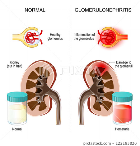 Glomerulonephritis. Kidney inflammation. 122183820