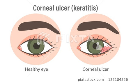 Illustration of corneal ulcer (keratitis). Healthy eye and eye with corneal ulcer. Medical infographic banner Illustration of corneal ulcer (keratitis). Healthy eye and eye with corneal ulcer. Medical infographic banner 122184236