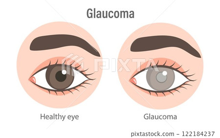 Glaucoma eye. Inflammatory, neovascular, traumatic glaucoma. Medical infographic banner Glaucoma eye. Inflammatory, neovascular, traumatic glaucoma. Medical infographic banner 122184237
