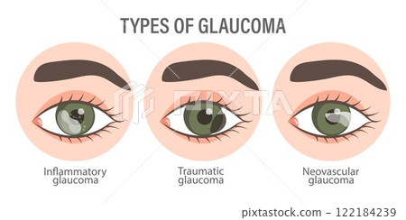 Types of glaucoma. Eyes with glaucoma. Inflammatory, neovascular, traumatic glaucoma. Medical infographic banner 122184239
