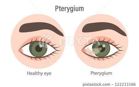 Pterygium. Healthy eye and affected eye. Medical infographic banner 122213166