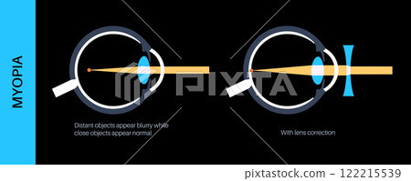 Myopia lens correction 122215539