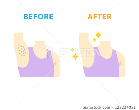 腋下除毛前後圖示的圖示 腋下除毛前後圖示的圖示 122224051