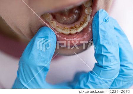 Dentist examining teeth with dental calculus and plaque where also fixed a retainer. Dentist examining teeth with dental calculus and plaque where also fixed a retainer. 122242673