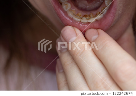 Closeup of teeth with dental stones and with a permanent bonded retainer. 122242674