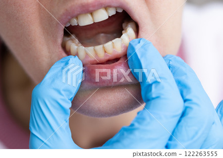 Dentist examining teeth with dental calculus and plaque. 122263555