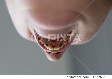 Closeup of dental calculus and plaque on the teeth. 122263556