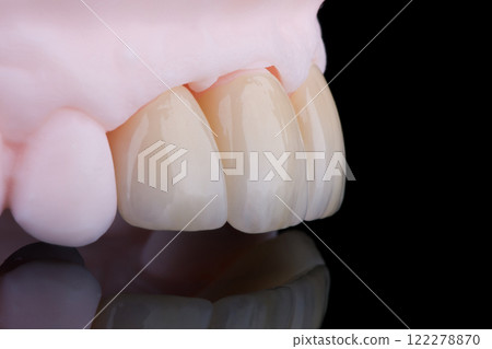 High-quality naturally dental crowns made of zirconia and stained like old man teeth. Side view High-quality naturally dental crowns made of zirconia and stained like old man teeth. Side view 122278870