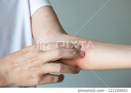 Young asian man itching and scratching on arm from allergic itchy dry skin eczema dermatitis insect bites Young asian man itching and scratching on arm from allergic itchy dry skin eczema dermatitis insect bites 122288091
