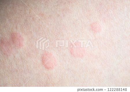 Skin allergy rash dermatitis texture close up Skin allergy rash dermatitis texture close up 122288148