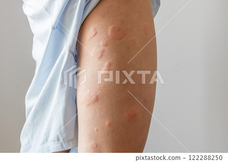 Young asian man has allergic skin rash on his legs from itchy dry skin eczema dermatitis insect bites 122288250