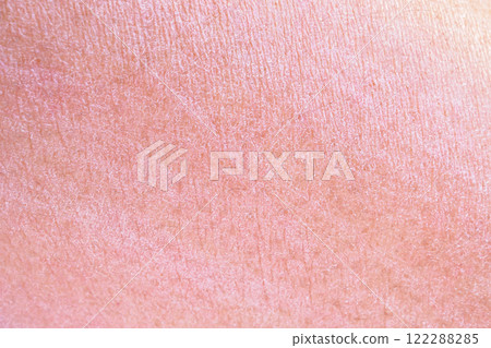 dry and dehydrated human skin texture background dry and dehydrated human skin texture background 122288285