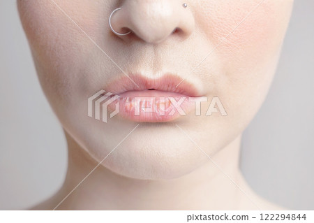 Dry, cracked lips in woman. Cold, wind, dryness close up photo need a hydrating, hygienic lip balm 122294844