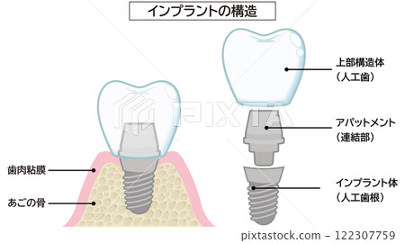 Implant 122307759