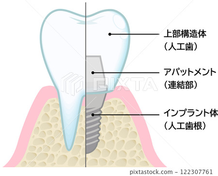 Implant 122307761