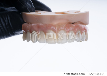 Full dental zirkonium prosthesis on titanium bar stained with stains for ceramic Full dental zirkonium prosthesis on titanium bar stained with stains for ceramic 122308435
