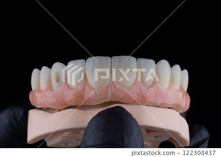 Full dental zirkonium prosthesis on titanium bar stained with stains for ceramic 122308437