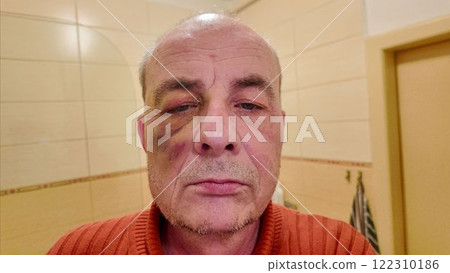 An elderly man examines the bruise on his eye in the mirror. A man with a bruise on his eye in the bathroom. The concept of violence and aggression An elderly man examines the bruise on his eye in the mirror. A man with a bruise on his eye in the bathroom. The concept of violence and aggression 122310186