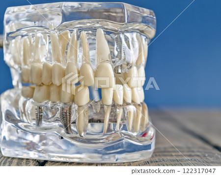 Full-Side View of a Transparent Dental Implant Model Featuring Artificial Teeth and Prosthetic Components 122317047
