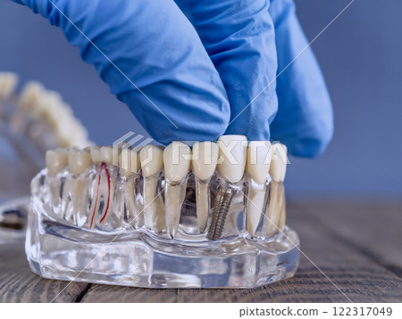 Side View of a Dental Implant Model with a Gloved Hand Adjusting Prosthetic Teeth on a Transparent Jaw for Clinical 122317049