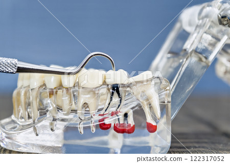 Detailed Dental Anatomy Model with Metal Instrument Demonstrating Root Canal Structure and Tooth Repair 122317052