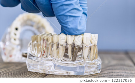 Transparent Dental Implant Model with a Gloved Hand Adjusting Prosthetic Teeth 122317056