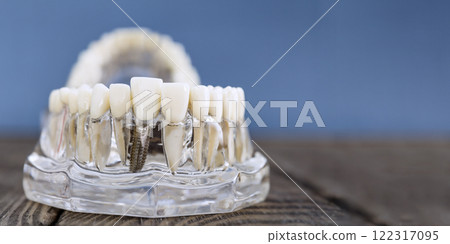 Dental Implant Model Showcasing Prosthetic Teeth on a Transparent Jaw for Educational and Marketing Purposes 122317095