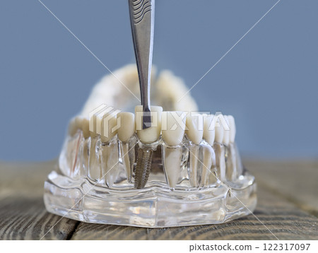Close-up of a dental implant model with a denture being adjusted with a dental instrument for educational and demonstration purposes 122317097