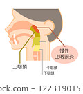 慢性鼻咽炎的說明圖/彩色/圖解_圖解 122319015