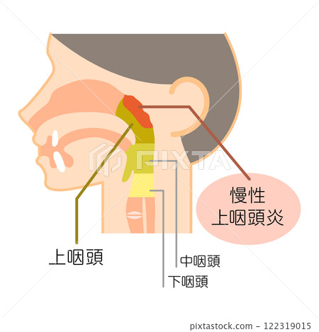 慢性鼻咽炎的說明圖/彩色/圖解_圖解 慢性鼻咽炎的說明圖/彩色/圖解_圖解 122319015