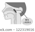 慢性鼻咽炎解釋圖，黑白，簡單圖解_圖解 122319016