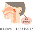 慢性鼻咽炎解釋圖解說,彩色,簡單圖解_圖解 122319017