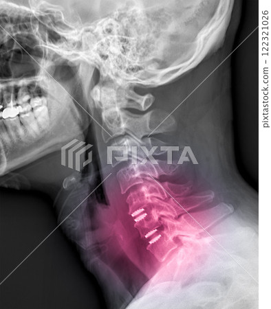 MRI of the cervical spine showing cervical myelopathy (cervical disc herniation, CDH) that causes neck pain and weakness MRI of the cervical spine showing cervical myelopathy (cervical disc herniation, CDH) that causes neck pain and weakness 122321026