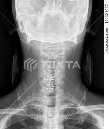 MRI of the cervical spine showing cervical myelopathy (cervical disc herniation, CDH) that causes neck pain and weakness 122321027