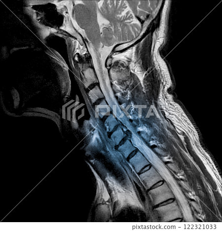 MRI of the cervical spine showing cervical myelopathy (cervical disc herniation, CDH) that causes neck pain and weakness 122321033